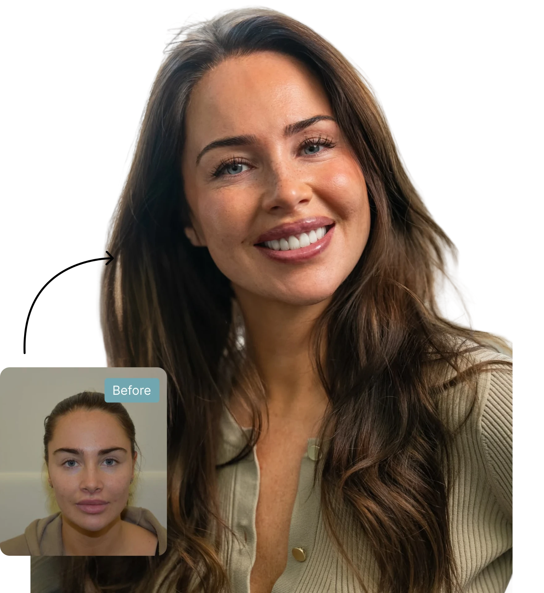 Female FUE hair transplant before and after result