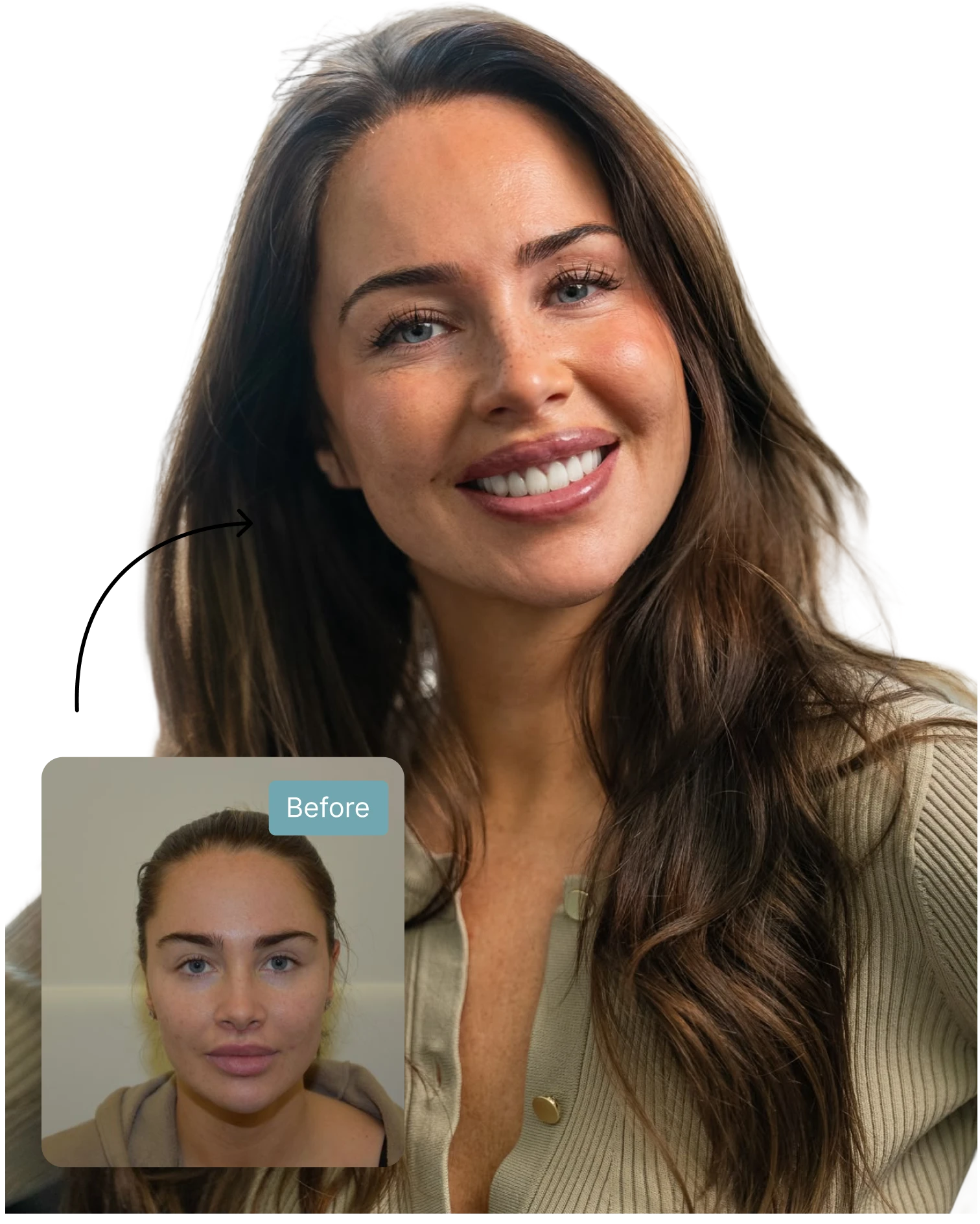 Female FUE hair transplant before and after result