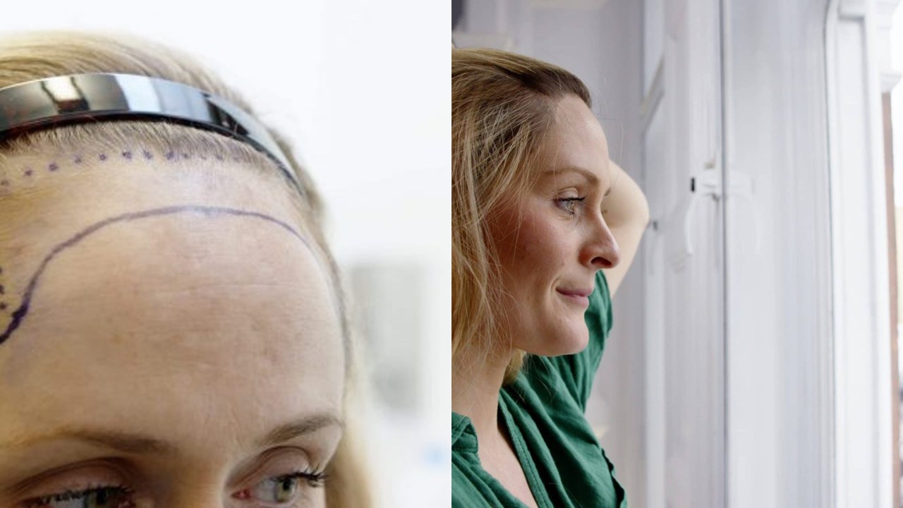 Carly before and after hair transplant