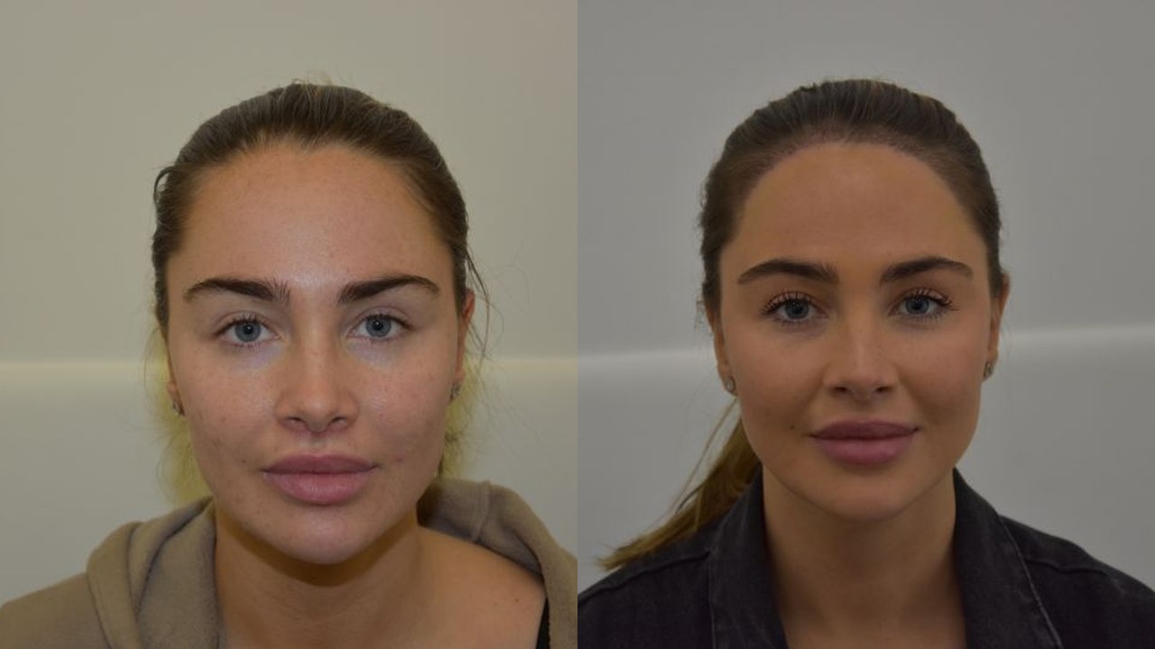 Johanna before and after hair transplant