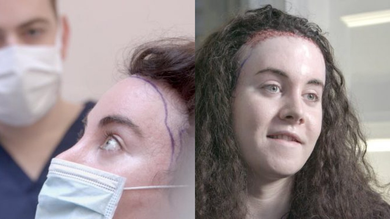 Charlie before and after hair transplant